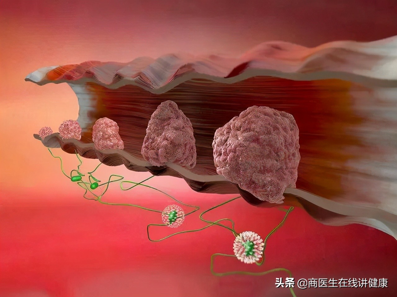 几个月内形成的浸润癌易复发么,浸润癌恶性