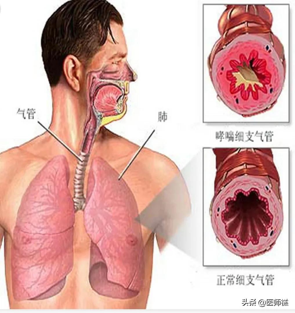 阿司匹林预防心血管,阿司匹林预防心脏的副作用与危害