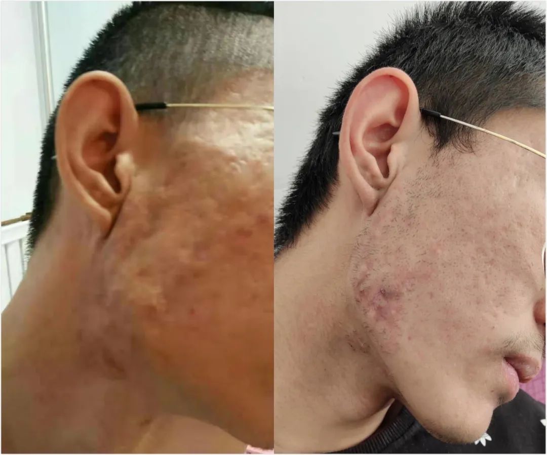 鼻子长痘留下凸起疤痕怎么消除,长痘留下的疤痕怎么祛