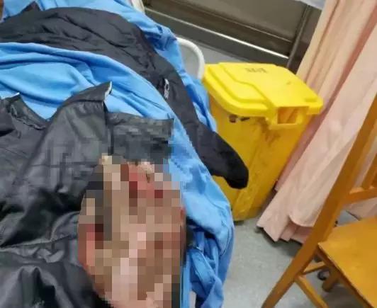 手机爆炸炸伤人严重事故,手机爆炸烧伤事件