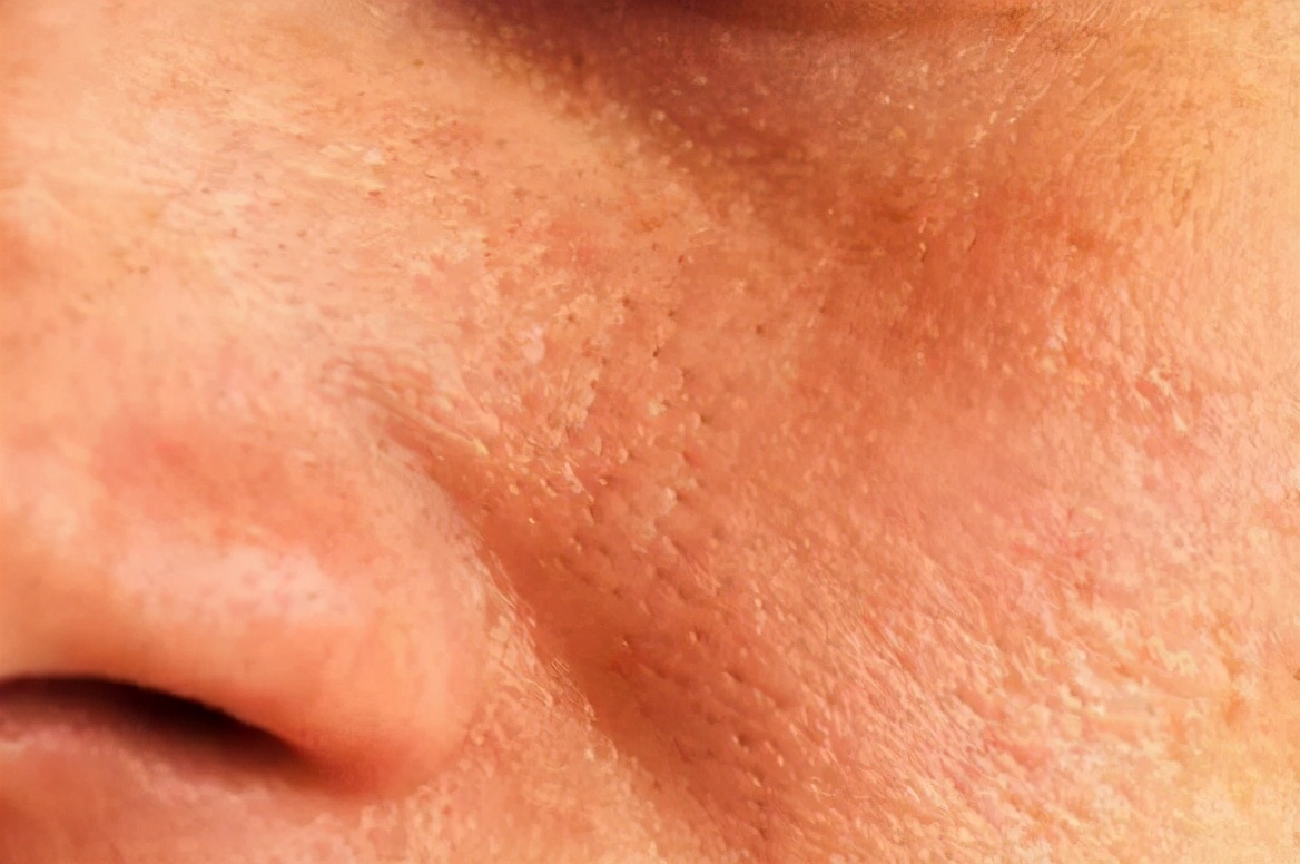 适合油皮长痘闭口黑头的护肤品,油痘肌黑头闭口