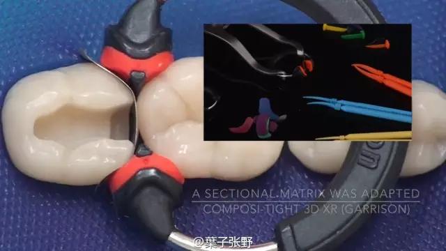 补牙疼吗补牙过程图,补牙全部过程是什么样子的