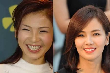 刘涛全瓷牙经验之谈,为什么刘涛说不要轻易做全瓷牙