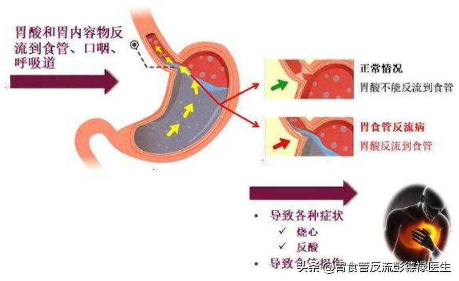 晚饭吃多了半夜胃难受怎么办,晚饭吃多了后到半夜就胃不舒服