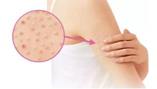 脸上有小米粒怎么消除摸起来刺痒,脸上的小米粒怎么去除小妙招