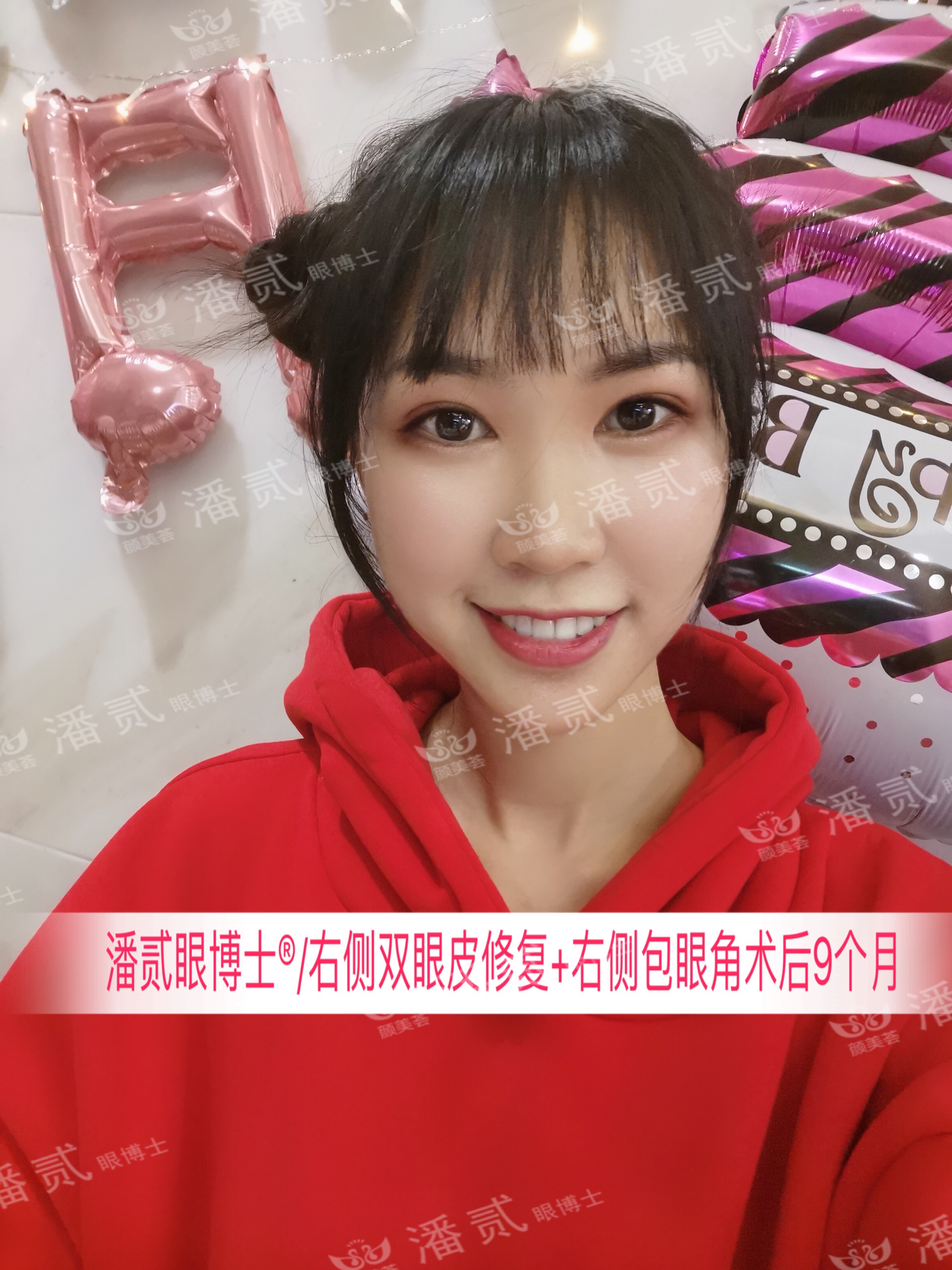 开内眼角会留疤的照片,开内眼角的疤痕变白色了怎么办