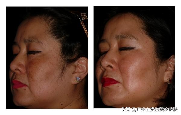 用氢醌祛斑没有效果,用氢醌乳膏淡斑还需要维a吗