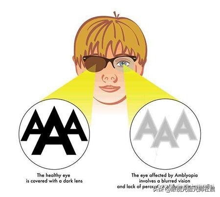 两只眼睛只有一只近视,一个眼睛近视了不戴眼镜会怎么样