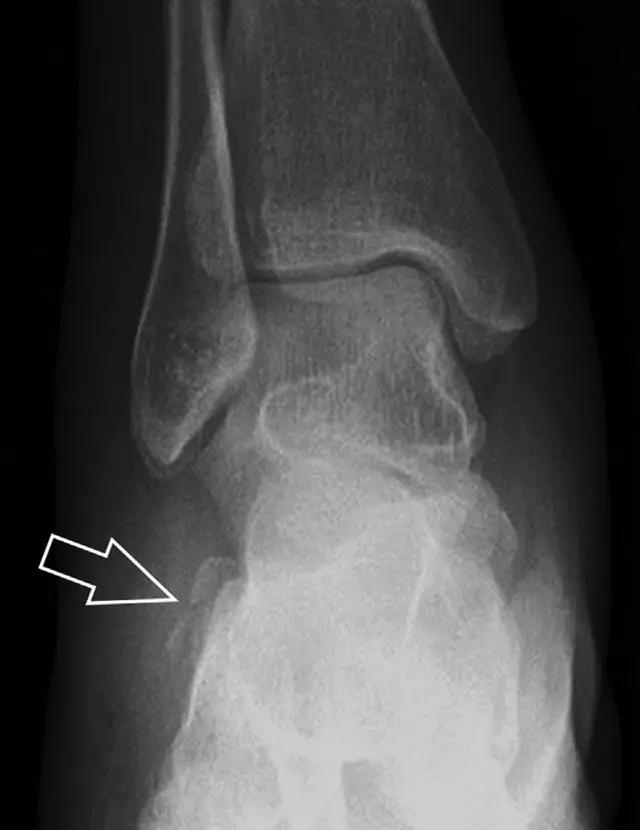 值夜班急救措施,放射科容易漏诊的骨折