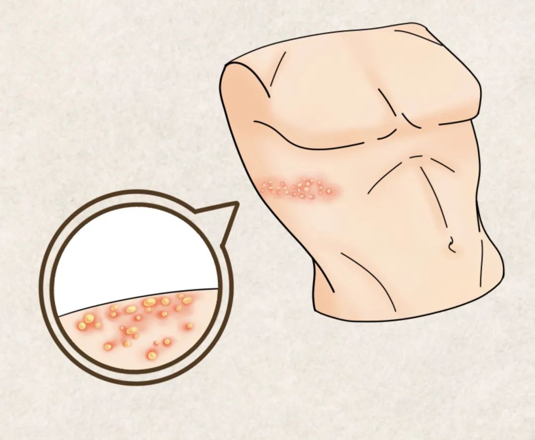 同事长了好多疮会传染吗,办公室同事陆续得了带状疱疹