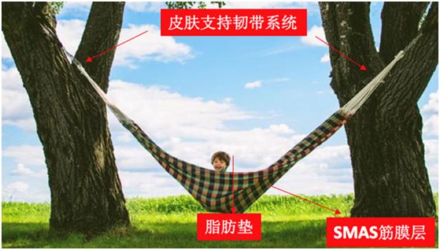 线雕和玻尿酸筋膜提升有什么区别,玻尿酸线雕是什么样子