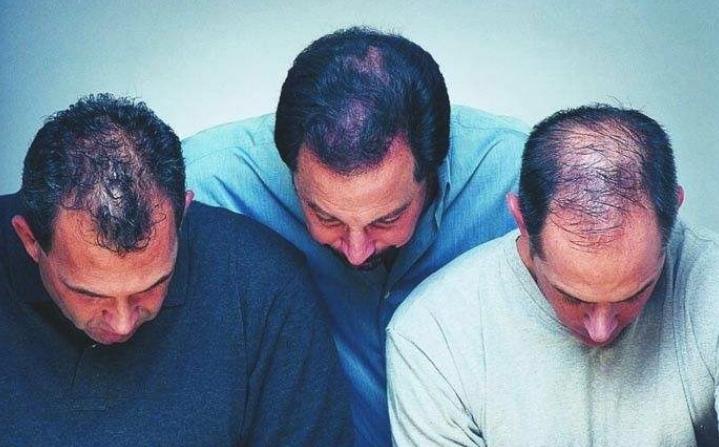 遗传性脱发怎么才能一劳永逸,遗传性脱发怎么治疗才有效