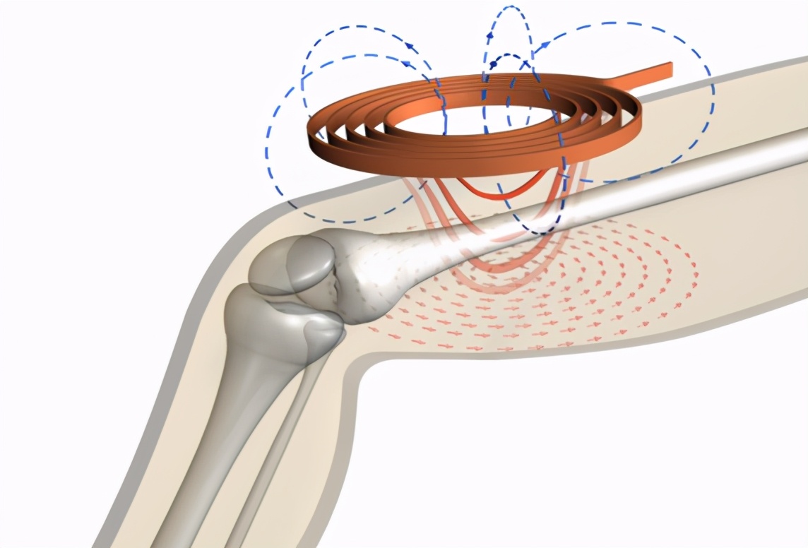 拒绝侵入式盆底肌刺激！让治疗更加舒适人性化的一款神器来了