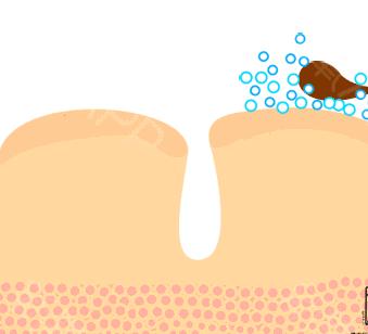 关于刷酸的那些事,刷酸的话题