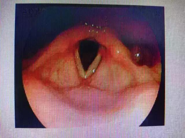 咽喉有异物感是喉癌吗,喉咙有异物感会是肿瘤吗