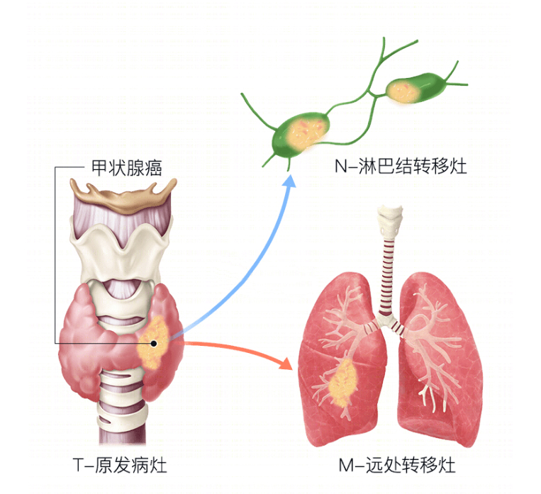 未分化甲状腺癌的症状和前兆,未分化甲状腺癌早期超声特点