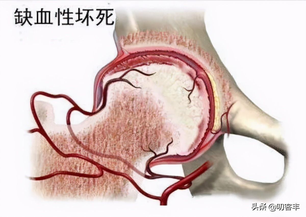 儿童股骨头缺血性坏死影响发育吗,孩子股骨头坏死症状
