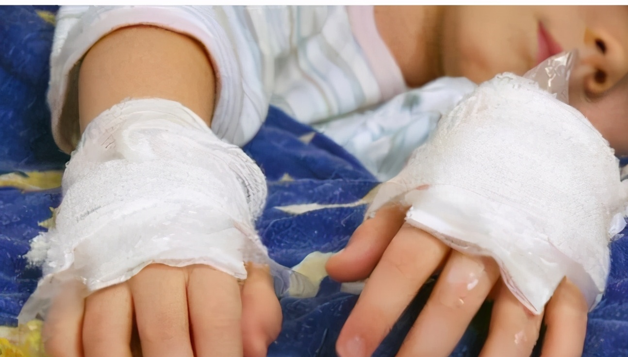 小孩被烫伤家人急救措施,孩子被烫伤家长应该怎么处理