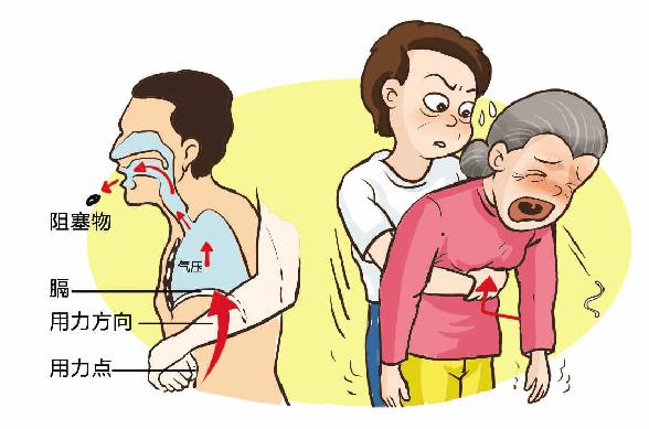 面条呛进气管三种急救方法,面条呛到鼻腔去医院怎么处理
