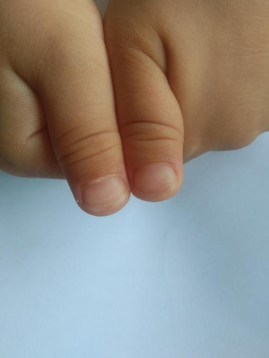 积食不化、反复发热、蒸笼头，问题这么多，从哪里入手好得快