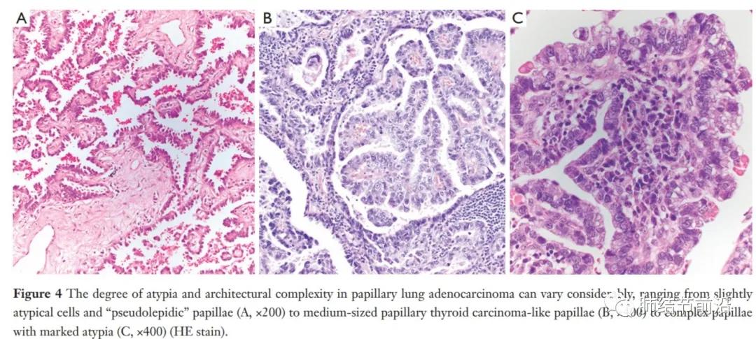 早期肺腺癌分哪几种,微浸润肺腺癌病理为什么没有分型
