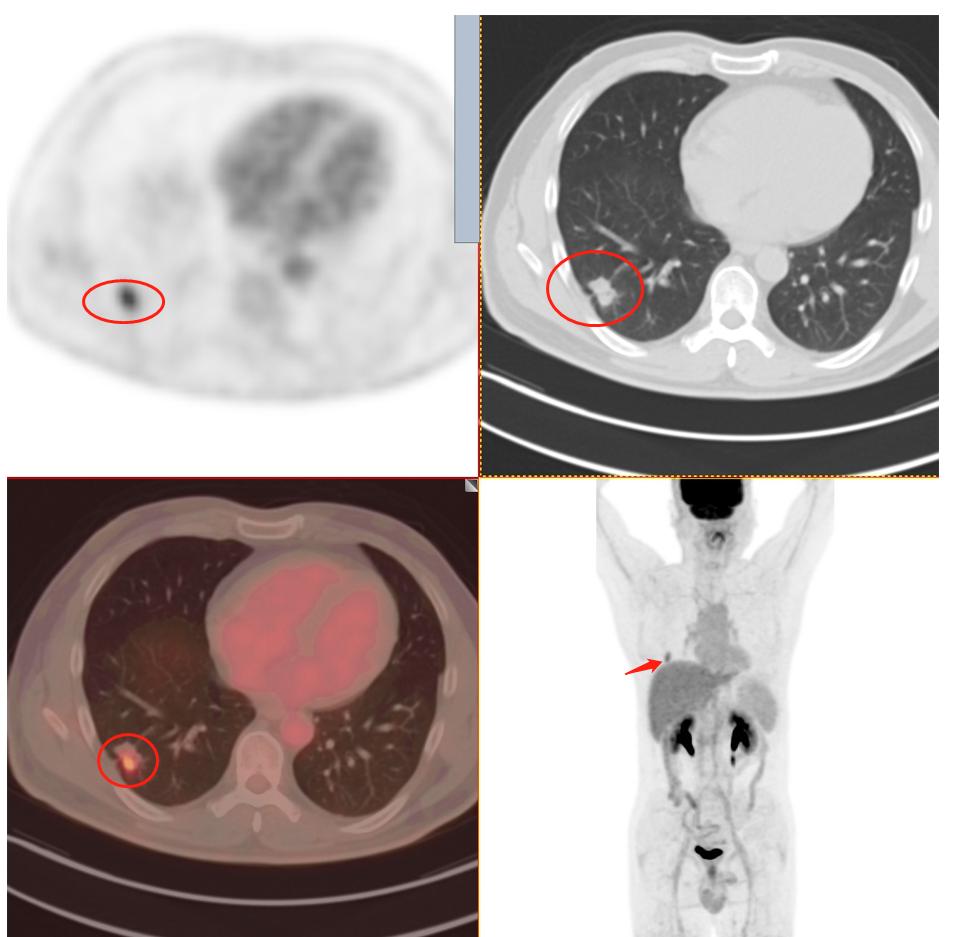 肺结节检查是薄层ct还是三维重建,肺结节检查用什么ct