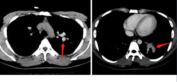 闻发霉的米饭会得霉菌性肺炎吗,发霉的果蔬馒头