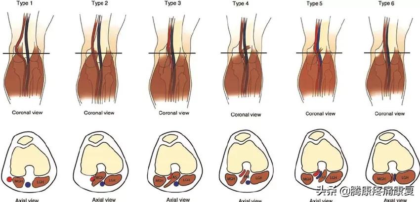 小腿疼痛的原因和治疗原则图片,脚小腿肌肉疼痛是什么原因