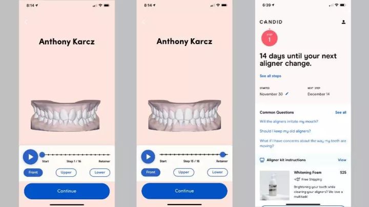 矫正牙齿3d打印隐形牙套,3d打印牙齿和牙套哪个效果好