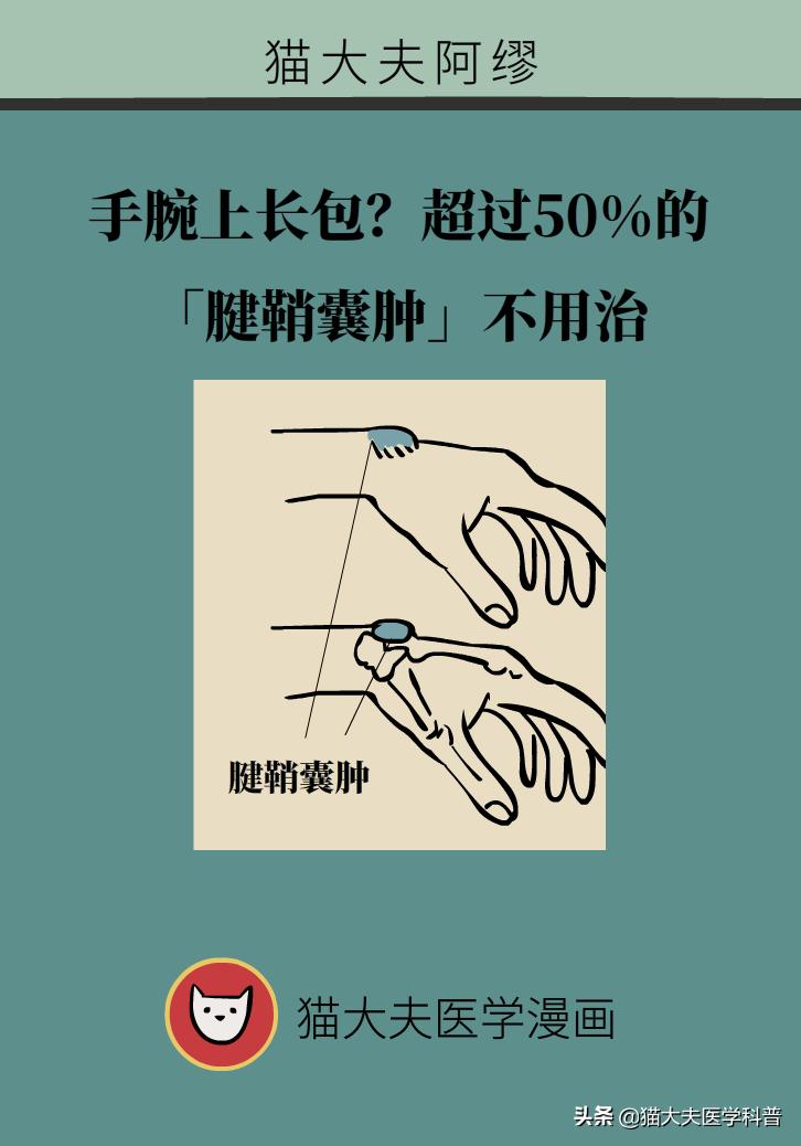 手腕长腱鞘囊肿,手腕上有个凸起的包腱鞘囊肿