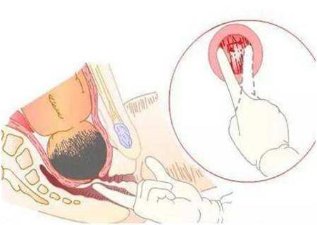 怀孕40周宫颈不成熟可以催生吗,孕38周可以塞水囊球催生吗