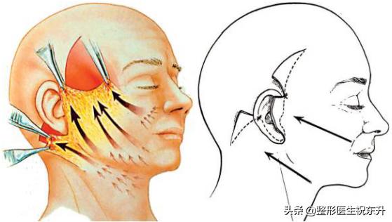 各种除皱方式你选对了吗,最权威最有效的除皱产品