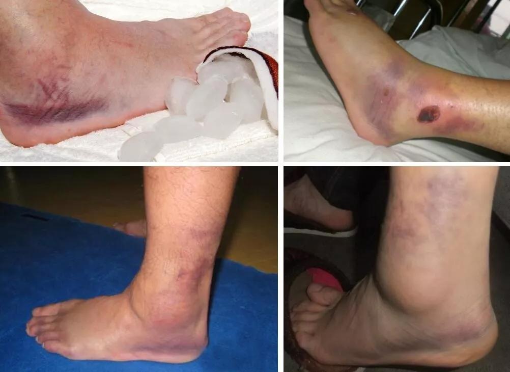 15岁小孩跑步后腿疼是什么原因,跑步几天后腿疼脚麻疼痛有针刺感