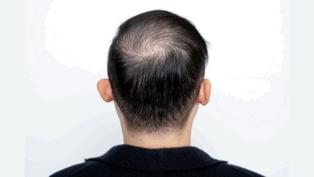 青少年脱发自救指南,青年脱发严重怎么治疗才有效