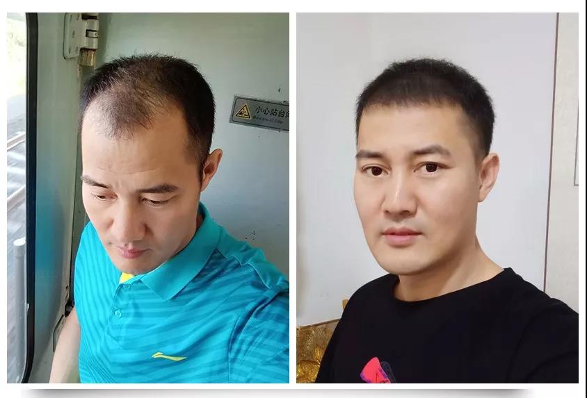 自体植发怎么移植,自体同源细胞移植植发