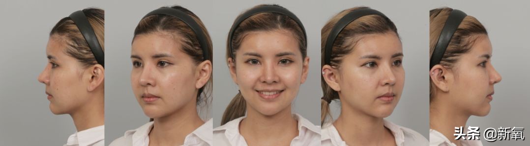 18岁土肥圆豪掷800万全身整形，鼻子6次大整假体穿出，效果却超美