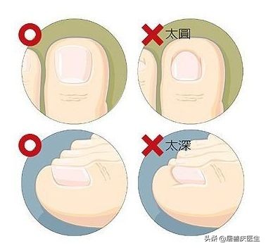 改掉啃手的习惯,拔肉刺引起甲沟炎