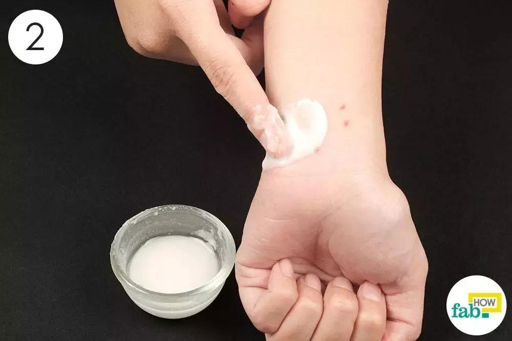 蚊子咬了用什么药膏止痒最快,蚊子咬了用什么药膏止痒快