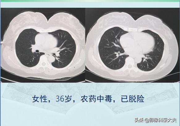 百草枯中毒事件25岁女生,百草枯25岁女孩中毒事件后续