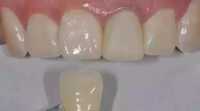 牙医用烤瓷牙冒充全瓷牙,怎么跟牙医说烤瓷牙换全瓷牙