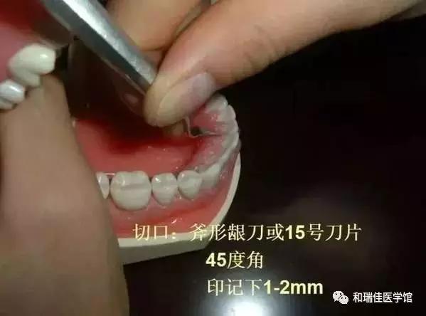 松牙固定需要什么条件,钢丝松牙固定操作流程