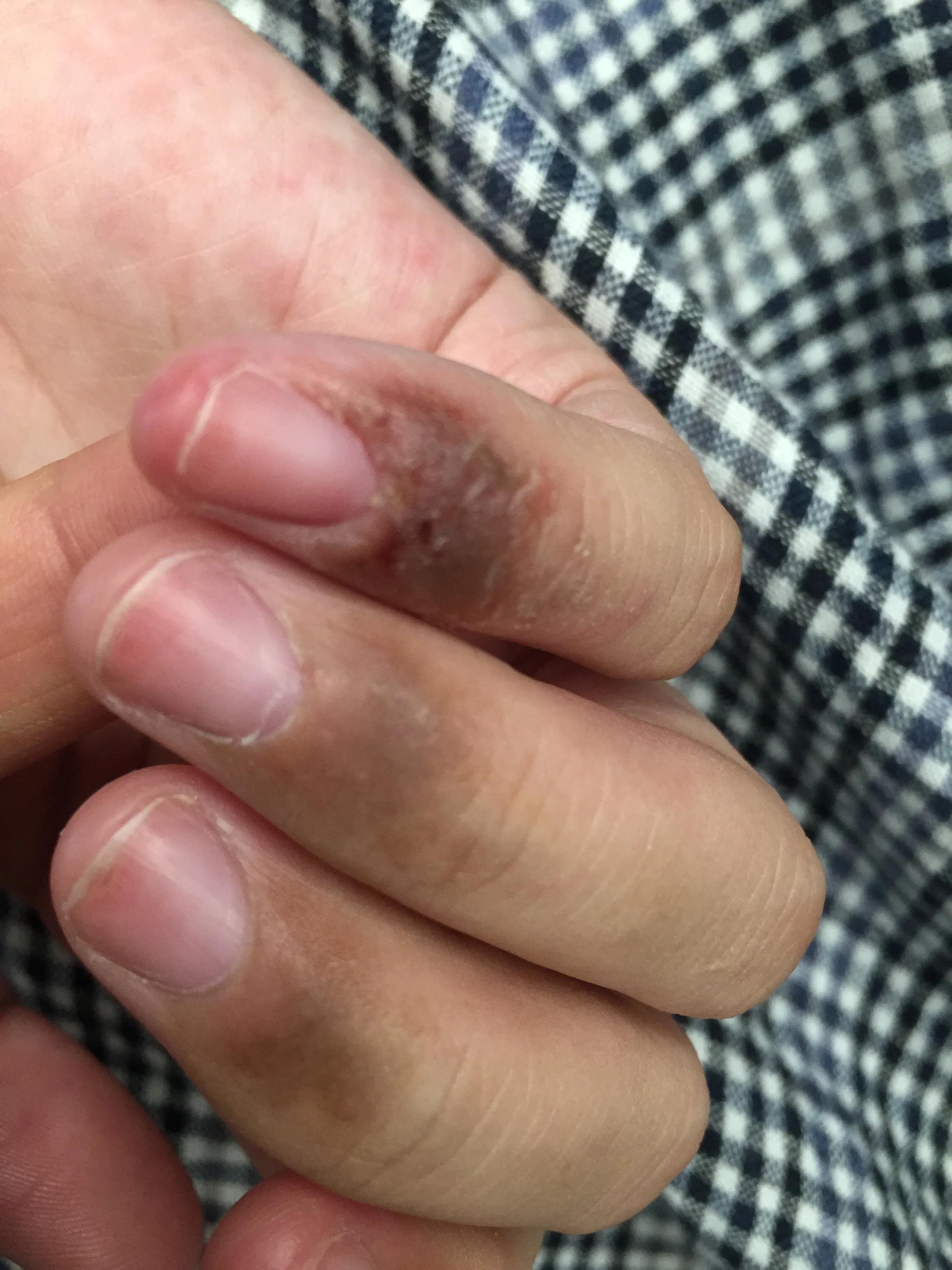 湿疹似乎是一种治不好的病,湿疹和痒疹是同一种病吗