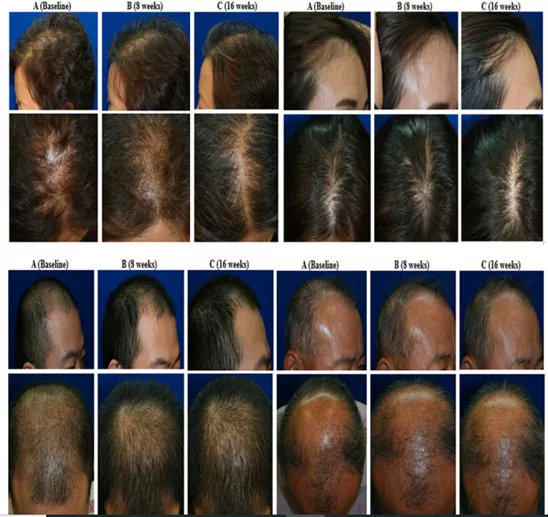 干细胞治疗秃头最新消息,干细胞治秃头