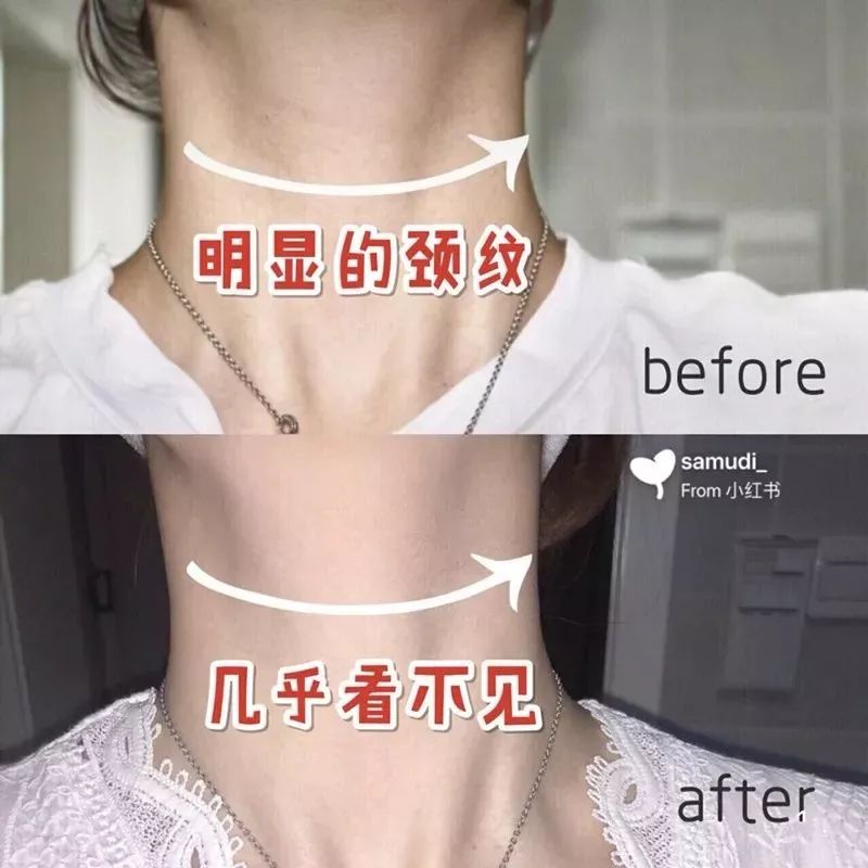 美容面部紧致提拉全过程,怎么做面部提拉改变大小脸