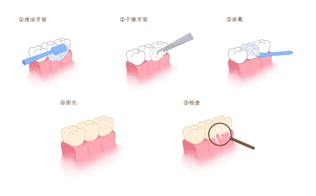 一岁宝宝乳牙龋齿涂氟,幼儿园涂氟防龋齿有必要做吗