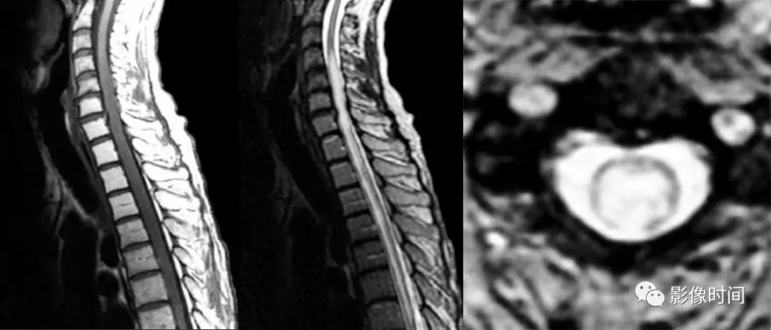 脊髓病变案例图文问诊,脊髓病变视频