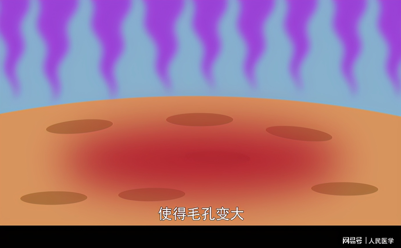 脸上出现像针孔大小的坑,脸上有很多像毛孔一样的坑怎么办