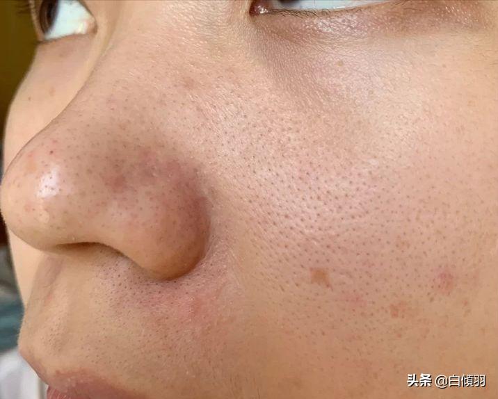 毛孔粗大全搞定这些知识要记牢,毛孔粗大真的能完全改善吗
