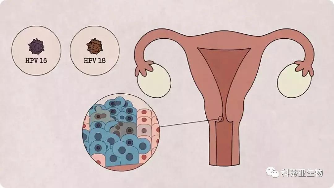 宫颈癌筛查是取哪些东西,宫颈癌筛查需要准备什么