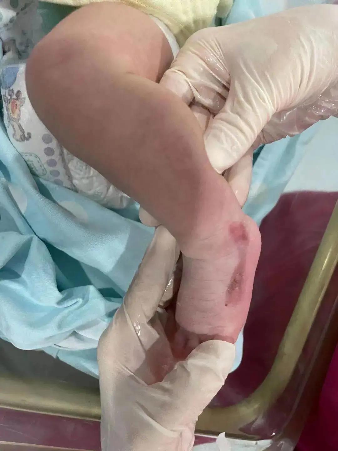 产检一路绿灯生下胎儿妈妈哭了,产检一路绿灯生下男婴却没有皮肤